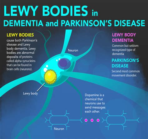 Lewy Body Dementia (LBD): What It Is, Symptoms & Treatment.